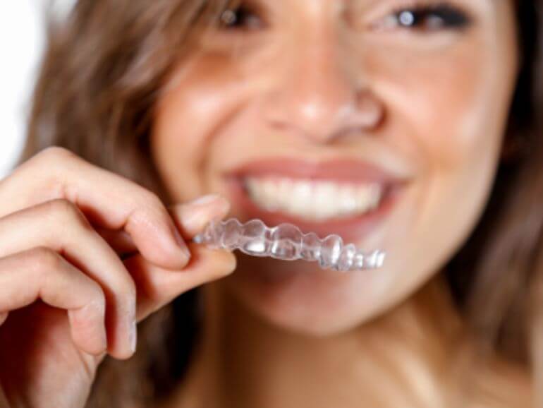 allineatori invisibili nuvola de toni